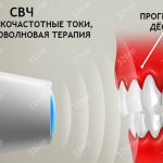 свч-терапия в стоматологии