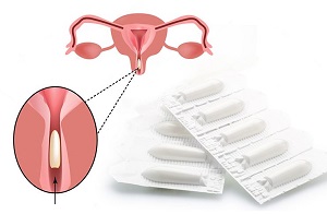 Применение вагинальных суппозиториев