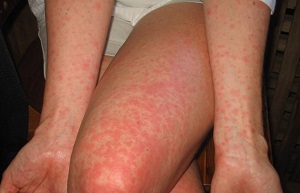 Аллергия на Триакутан мазь