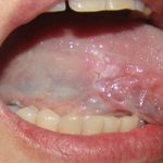 Почему болит язык сбоку и как его вылечить