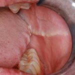 Травматический стоматит возникает из-за порезов слизистой ротовой полости остатками зубов, случайных прикусов языка, щеки