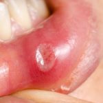 травматический стоматит на нижней губе