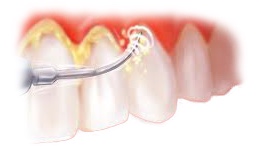 ультразвуковое удаление зубного камня