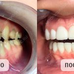 Что такое виниры для зубов и какие лучше
