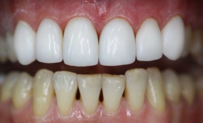 виниры и обычные зубы