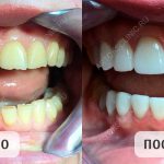 Что такое виниры для зубов и какие лучше