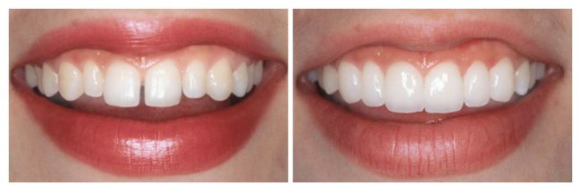 до и после установки виниров на передние зубы