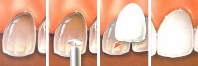 схема установки винира на зуб