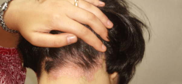 Как лечить псориаз волосистой части головы: стадии, симптомы и причины