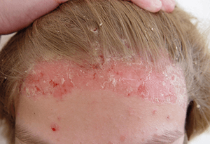 Как лечить псориаз волосистой части головы: стадии, симптомы и причины
