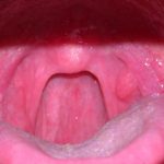 воспаление мягких тканей рта