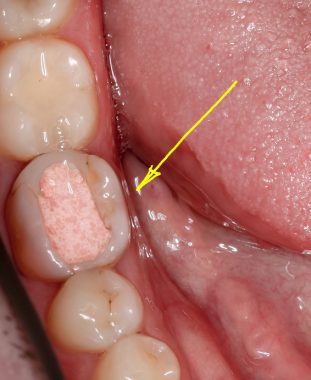 временная пломба в зубе