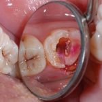 зуб с выпавшей пломбой