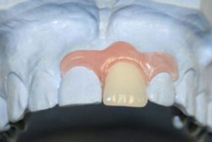 временный съемный зубной протез