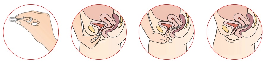 противозачаточные контрацептивы Кольцо НоваРинг