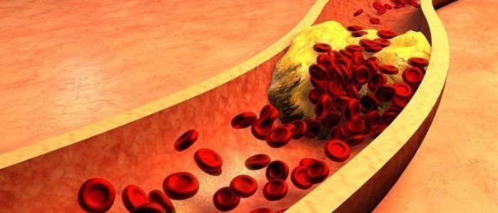 Как уменьшить холестерин в крови?