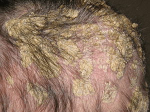 Жирная себорея кожи головы: методы лечения