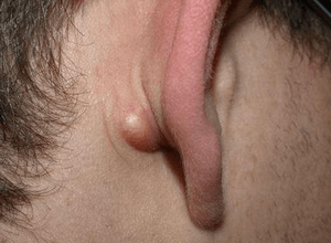 Липомы за ухом: методы лечения
